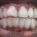 Week 1 (with attachments and aligners)