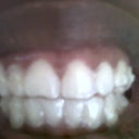Week 3 (with attachments and aligners)
