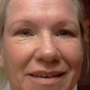 1 month after, close up no makeup, what a difference!!!