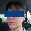 Seven days after laser. You can still see how pink the subcision areas are. Subcision was two weeks ago. I have makeup on. This is my better side -- the left. Very happy with result on this side.