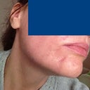 Seven days after laser. You can still see how pink the subcision areas are. Subcision was two weeks ago. No makeup. Right side and my bad side. Looks better. That spot really plumped up. (The one below the corner of my mouth.)