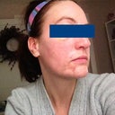 Seven days after laser. You can still see how pink the subcision areas are. Subcision was two weeks ago. No makeup. Bad side. Think cheeks look great.