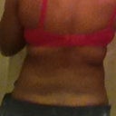 Back 1 day after surgery