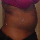 Side 1 day after surgery