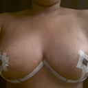 Hoping these nips are aligned right & I am just a bad photog
5 days post op