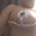 5 days post op