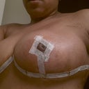 5 days post op