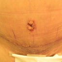 10 day PO...Before my shower. My tummy scar and new bellybutton.