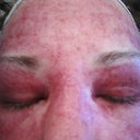 Close-up of eyes and nose - very swollen - day 3.
