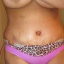 Holding my breasts up, this is to show what my thighs looked like. Chafing was a major problem any time I ran (which is every day)