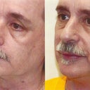 Anthony Before and After