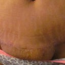 Used the Scar FX strips on this area for 4 days, and see vast imporvment already the area above my swollen Vj is looking so thin and fine already