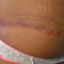 This is the side where I had the popped stitch I had a scar cream rejuvsil it is one of those silicone creams I have been using on the long part of each side since I cant get the strips to lay  there properly