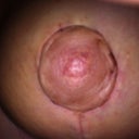 Nipple healing up good! 2 weeks post op!
