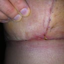 Here is the little area of my concern, I KNOW its not that bad, but just hoping this looks like part of the normal healing process?!! 2 weeks post op!