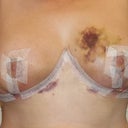 Post op day 12-still swollen and hard on the sides