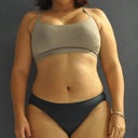 left - 1 week post