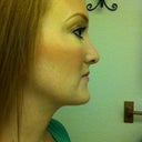 Updated of chin after 3 months. By far my favorite!
