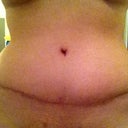21 days post op with seroma