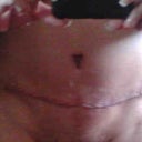 Day 7 Post op just after first shower. Stitches are out and tub is out. I was brave and put on old jeans that are a Levis size 30-32 and they fit snug but I am still swollen. So I think I will be a bit smaller soon. I have been told that I can lift up to 20lbs. So Now I will with help start doing more stuff. Now I have the ability do more but no Omega 3 or vit. E as of yet.