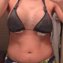 Day 1: After surgery