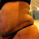 post almost 4 weeks
left side still puff on the side. I'm not that happy about the swollen sides above scar