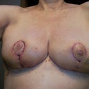 1 week post op... loving the size! c cup