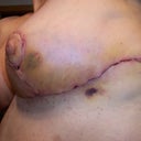 Left side view 1 week post op ... not real pretty looking