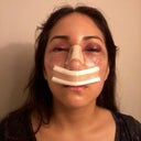 After- Day after surgery am very swollen