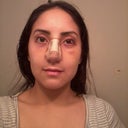 After-6 days after surgery and the last day with my cast on (frontal view)