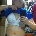 Few hours after Surgery (front view)