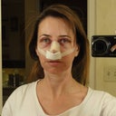 Front view, 12 hours postop.  Ewww! LOL!