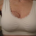 2 weeks today, the scar on top of my right breast is from melanoma, i had it repaired at the same time as my BA.