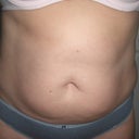 Pre-op