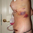 Day 3 post op side view