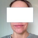 One month later - inside shot. No makeup. Just moisturizer.