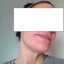 One month later - another inside shot.No makeup. Just moisturizer.