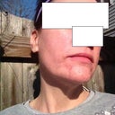 One month later. Outside. No makeup. I do have a moisturizer with sunscreen.
