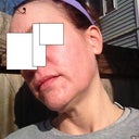 One month later. Outside. No makeup. I do have a moisturizer with sunscreen.