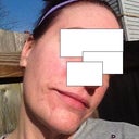 One month later. Outside. No makeup. I do have a moisturizer with sunscreen.