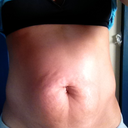 before pic morning of surgery