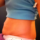before pic morning of surgery