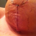 Left Incision
(Sorry for the gross shot)