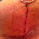 Right incision 11 days post op