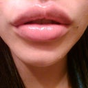 Immediately after injections. 