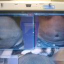 before surgery/4weeks later