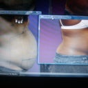 before surgery/4weeks later