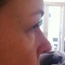 Dropped eyelids after too much botox injected into forehead