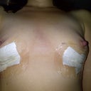 Front view 7 days - different angle to show the caving of the right nipple