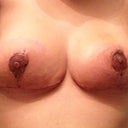 13 days post op-still a little red but looking good!